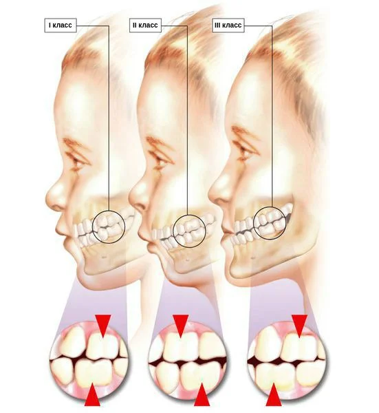 мезиальный прикус фото