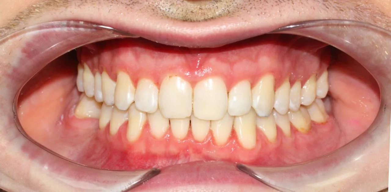 Ортодонтическое лечение на системе Click