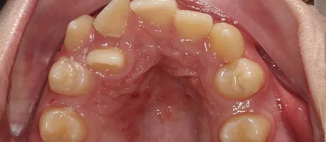 Исправление дистопии зубов