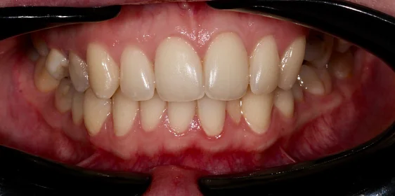 Лечение аномалии соотношения зубных дуг элайнерами