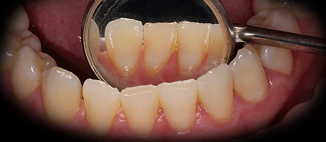 Снятие зубных отложений с помощью ультразвука и аппарата Air-Flow