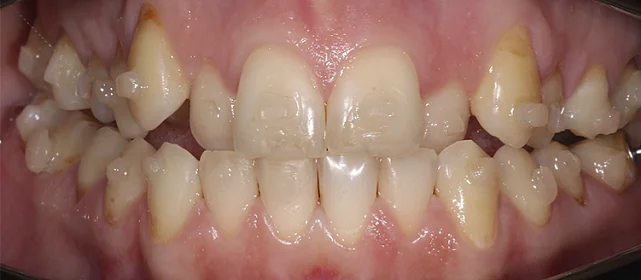 Исправление мезиального прикуса