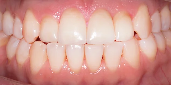 Лечение прикуса с последующей ортопедией верхних зубов