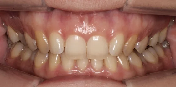 Ортодонтическое лечение на элайнерах