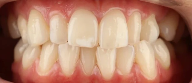 Коррекция аномалии положения зубов на элайнерах