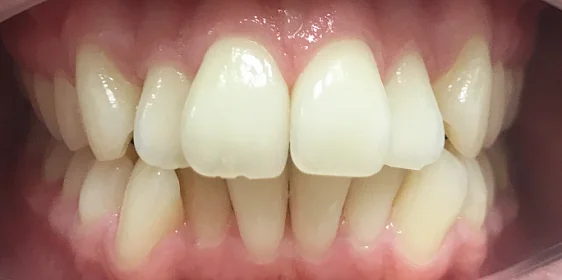 Исправление фронтальной группы зубов капами Инвизилайн
