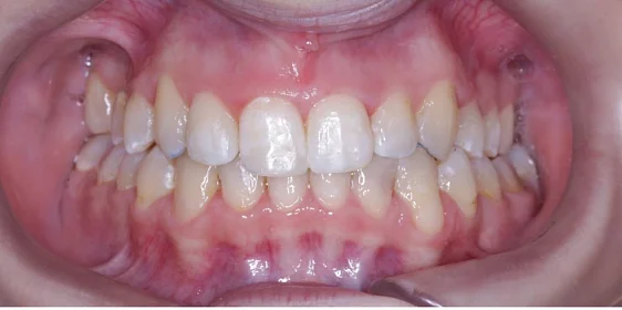 Ортодонтическое лечение на элайнерах