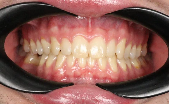 Ортодонтическое лечение на системе Click