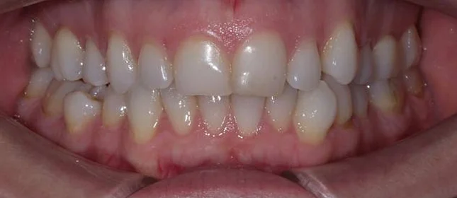 Лечение неправильного прикуса элайнерами