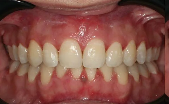 Ортодонтическое лечение на брекет-системе