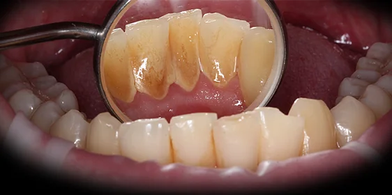 Удаление камней и профессиональная гигиена для последующего лечения кариеса