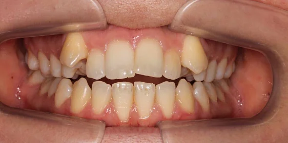 Корреция открытого прикуса элайнерами