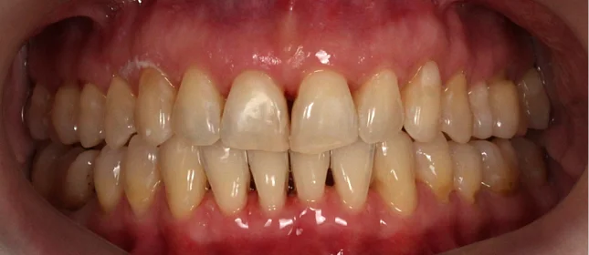 Коррекция аномалии соотношений зубных дуг элайнерами