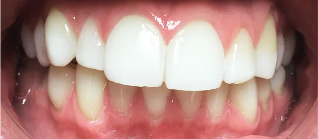 Лечение дистального прикуса с последующим ретенционным периодом