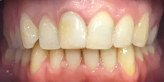 Исправление прикуса