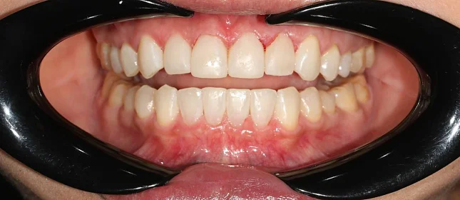 Ортодонтическое лечение на элайнерах №10