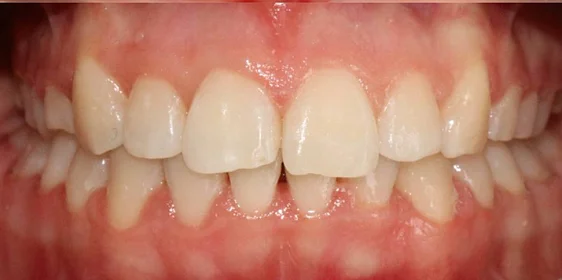 Ортодонтическое лечение нa брекет-системе