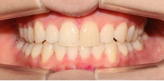 Ортодонтическое лечение на системе Click