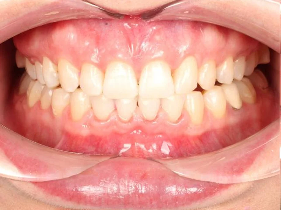 Коррекция дистальной окклюзия на брекет-системе