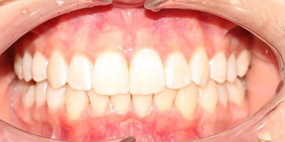 Ортодонтическое лечение на элайнерах