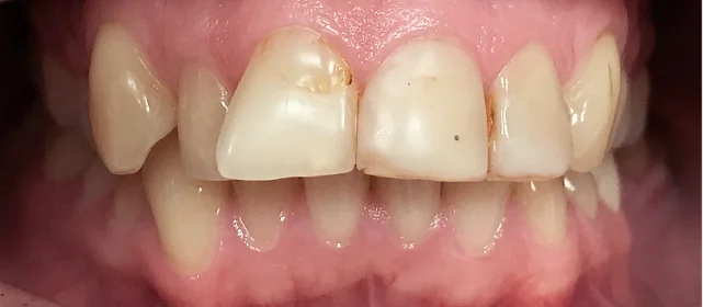 Подготовка зубных рядов к последующей установке виниров