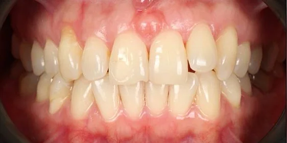 Лечение прикуса на брекет-системе