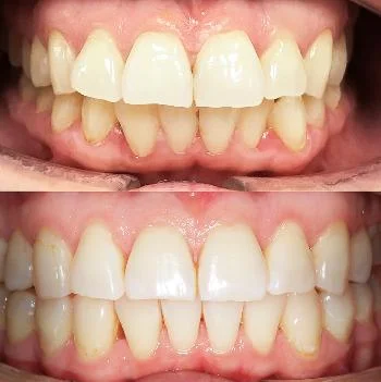 Устранение бипротрузии верхних и нижних резцов