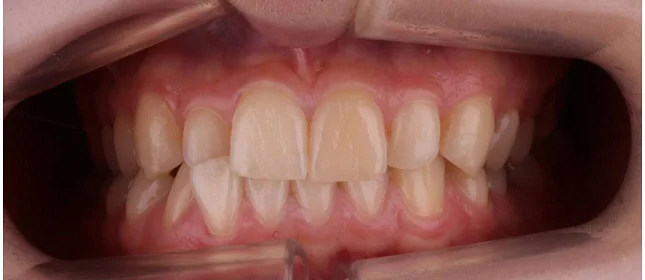 Ортодонтическое лечение на системе Click №2