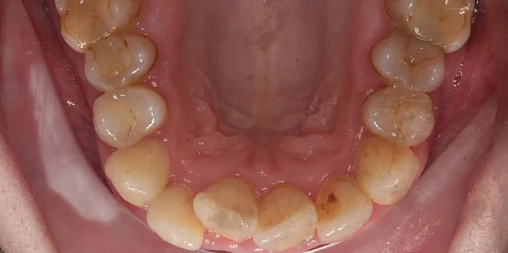 Лечение на Invisalign