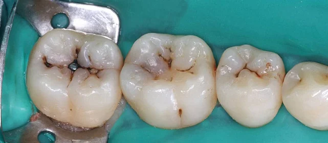 Реставрация зубов