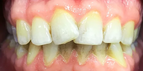 Исправление одностороннего дистального прикуса