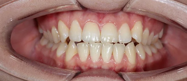 Ортодонтическое лечение на элайнерах №1