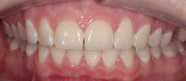 Коррекция дистального прикуса элайнерами