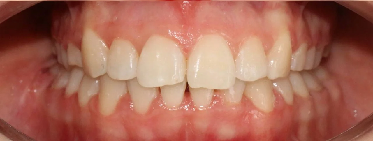 Ортодонтическое лечение нa брекет-системе