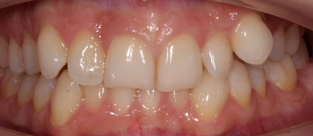Ортодонтическое лечение на элайнерах №7