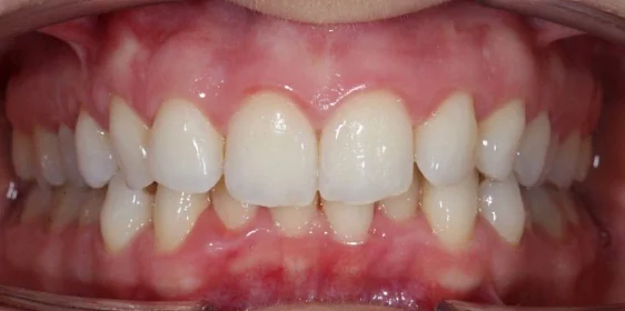 Лечение скученности зубов на элайнерах