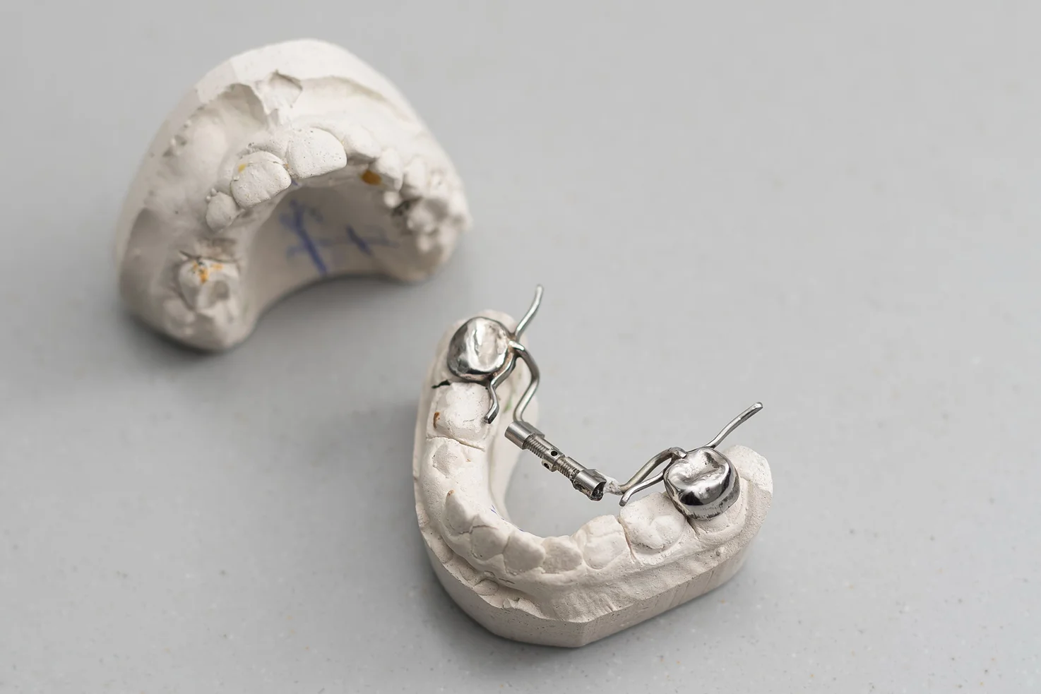 Имплантация зубов