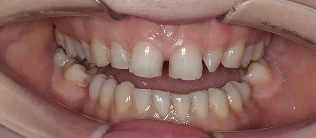 Исправление прикуса и закрытие промежутков