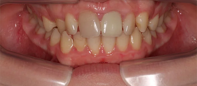 Исправление дистального прикуса элайнерами