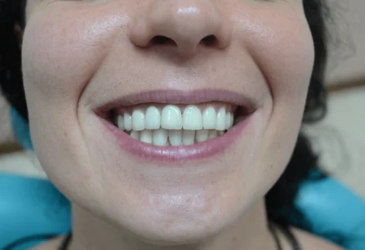 зуб под коронкой фото