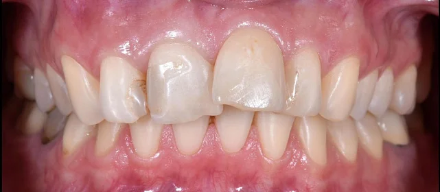 Сужение верхней челюсти, скученное положение зубов. Срок лечения 16 месяцев