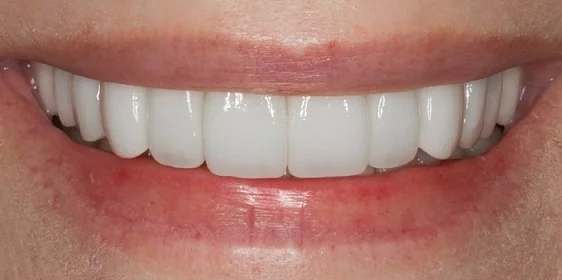 Установка виниров