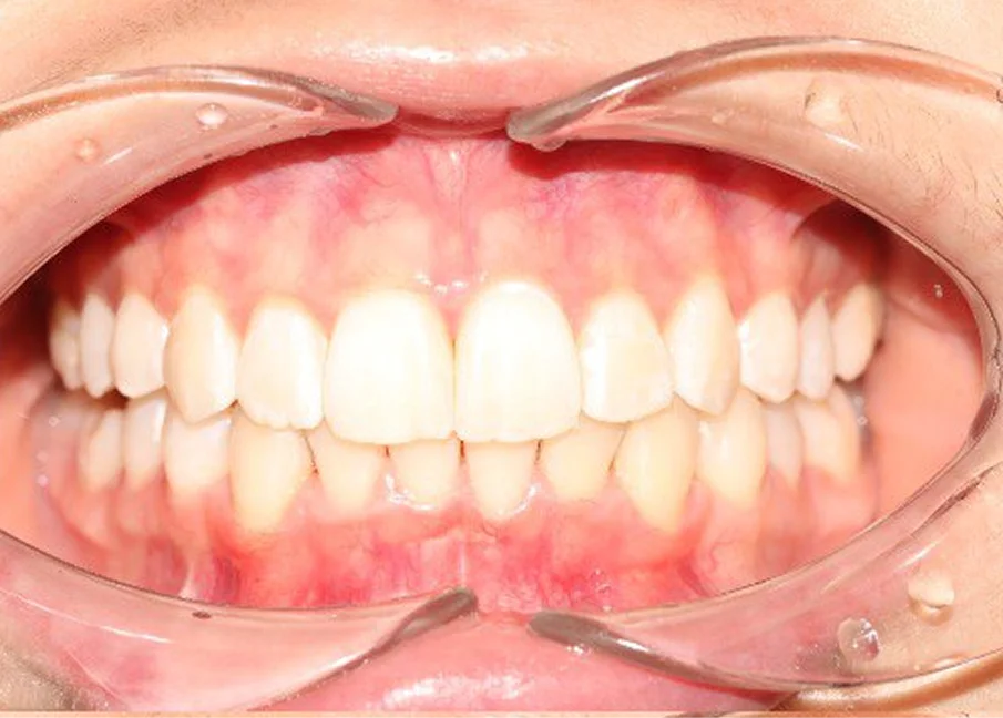 Ортодонтическое лечение на элайнерах