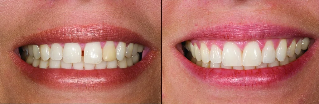 лечение пластикой