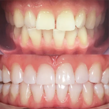 Исправление прикуса элайнерами Инвизилайн