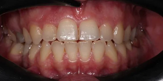 Лечение аномалии соотношений зубных дуг на элайнерах