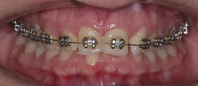 Исправление скученности лигатурными брекетами