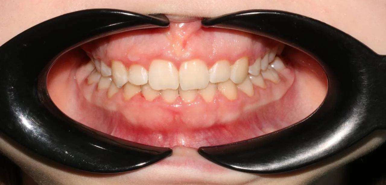 Лечение скученности зубов на брекет-системе