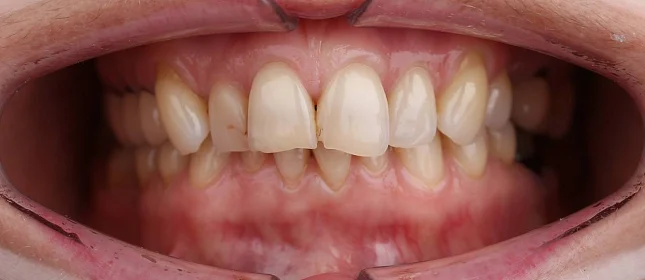 Лечение скученности зубов на брекет-системе