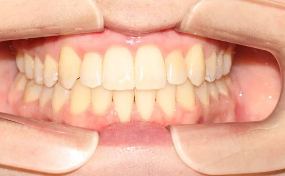 Корреция открытого прикуса элайнерами